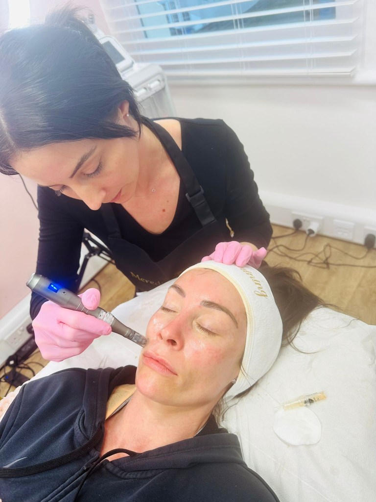 Sarah Bowers performing a microneedling facial on a client, who is lying on a treatment bed with her eyes closed.