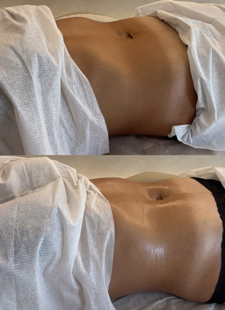 Before and after images of Brazilian Lymphatic Drainage massage on tummy, showing a before photo of a more bloated torso, and an after photo of a more sculpted, less bloated torso.